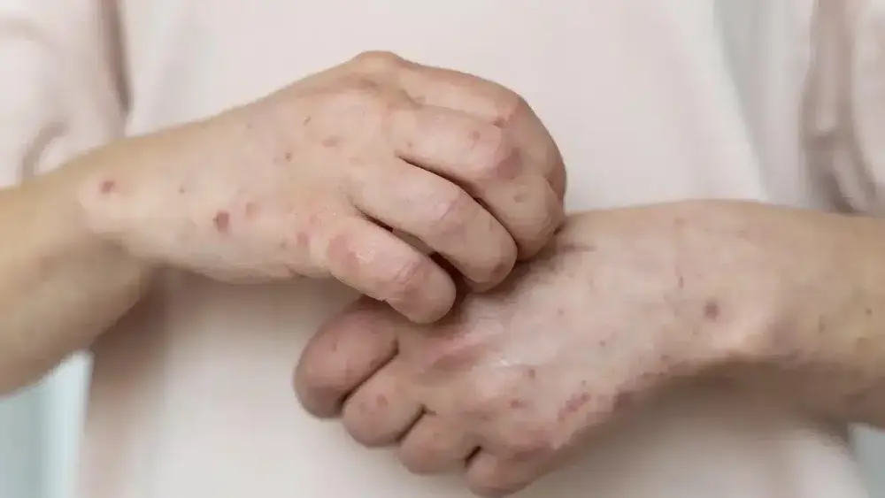 Sarampo mata 2 nos EUA; vítimas não eram vacinadas